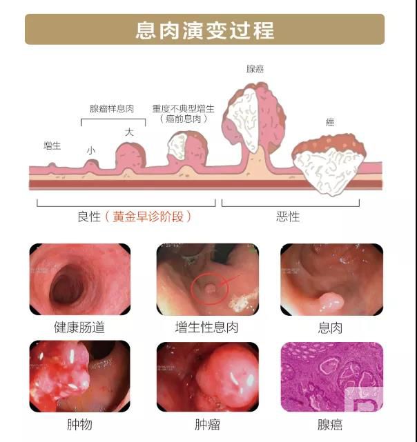 山西肛泰肛肠医院：排便出现这四大症状，年过40岁千万要注意！