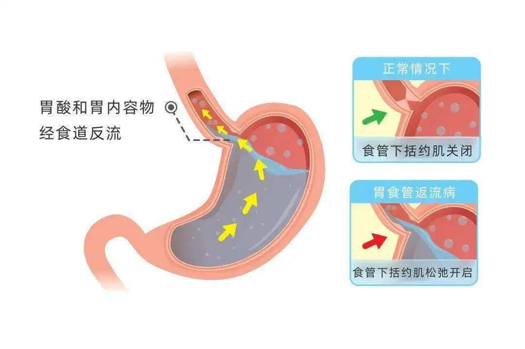 山西肛泰肛肠医院：胆汁反流和胃酸反流有什么差别