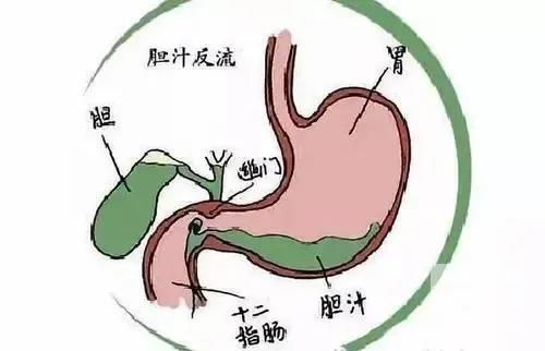 山西肛泰肛肠医院：胆汁反流和胃酸反流有什么差别