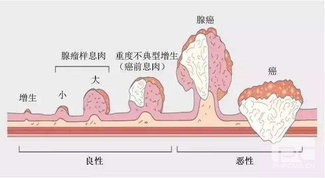 山西肛泰肛肠医院：患有肠息肉有哪些特征？