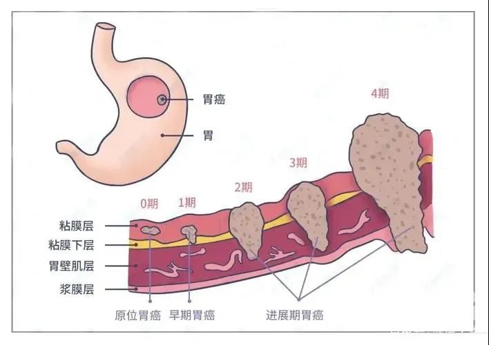 山西肛泰肛肠医院：这5类人必须尽早做胃镜！