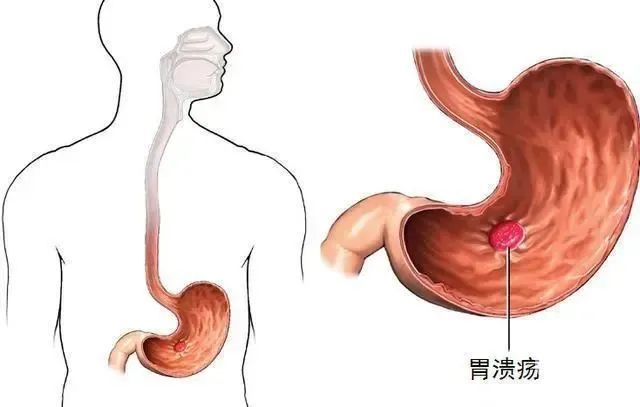 山西肛泰肛肠医院：经常拉黑色大便是怎么回事？严重吗？