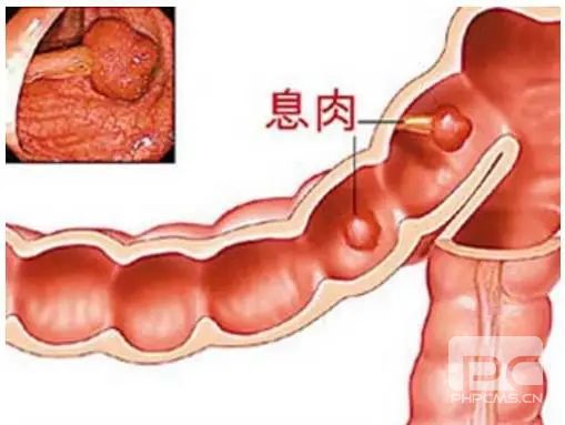 山西肛泰肛肠医院：肚子里的“定时炸弹”——肠息肉！