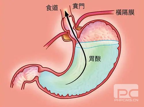 山西肛泰肛肠医院：胃酸应远离这7种食物