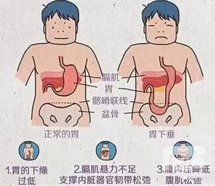 山西肛泰肛肠医院：如何预防胃下垂