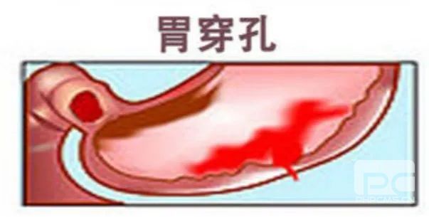 山西肛泰肛肠医院：胃溃疡的这7种症状需警惕！