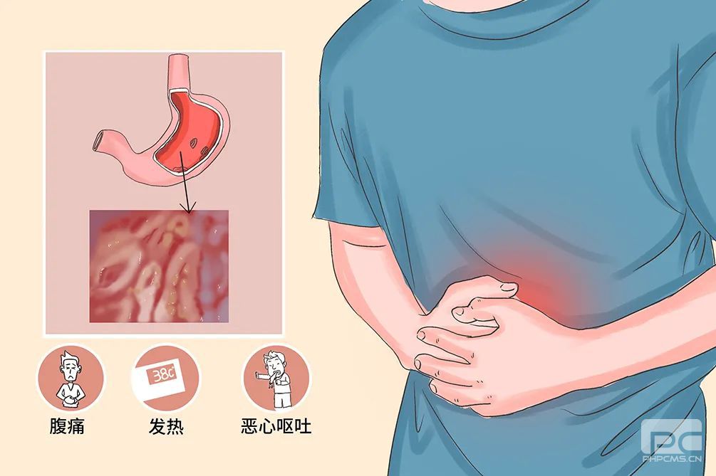 山西肛泰肛肠医院：急性胃炎的分类