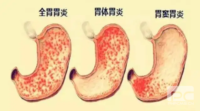 山西肛泰肛肠医院：你了解胃窦炎吗？