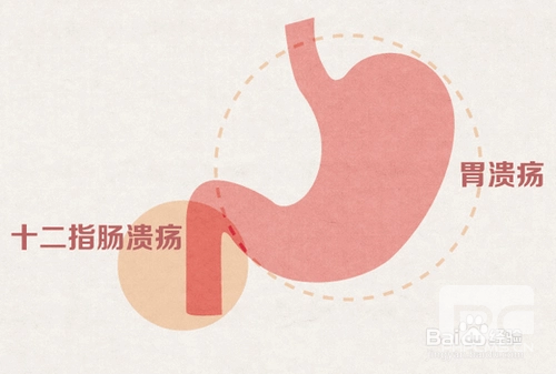 山西肛泰肛肠医院：得了胃溃疡要怎么调理？