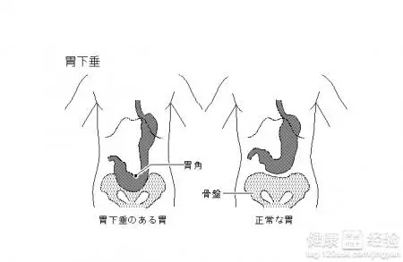 山西肛泰肛肠医院：胃下垂会有什么危害？