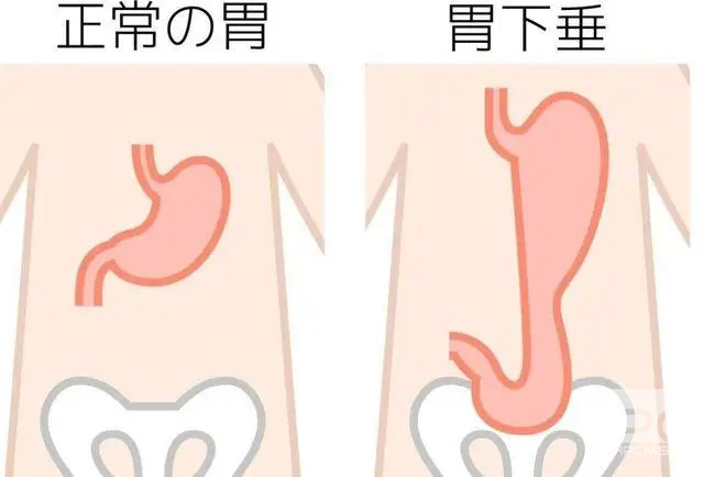 山西肛泰肛肠医院：胃下垂的种类有哪些？
