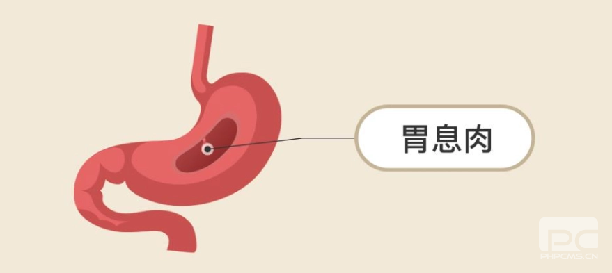 山西肛泰肛肠医院：胃息肉会带来哪些危害？