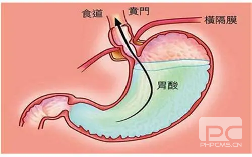 山西肛泰肛肠医院：胃酸过多吃什么好？
