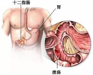 山西肛泰肛肠医院：胃溃疡的饮食调理八大原则