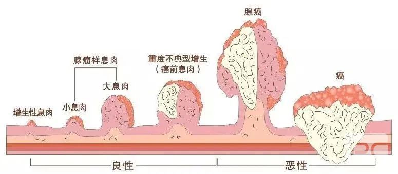 山西肛泰肛肠医院：胃息肉是否癌变？和这些特点有关