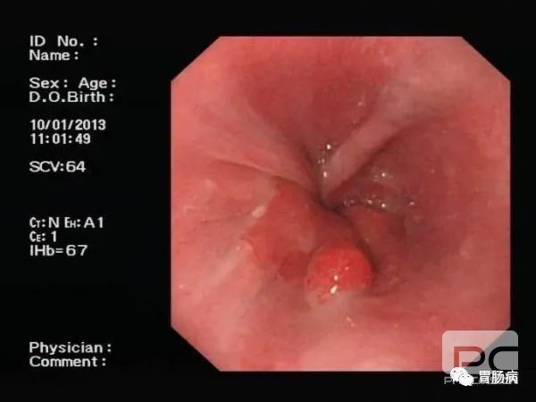 山西肛泰肛肠医院：好好认识一下什么是胃息肉？