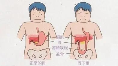 山西肛泰肛肠医院：如何预防胃下垂？