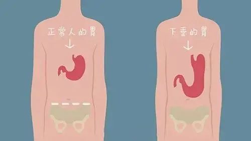 山西肛泰肛肠医院：导致胃下垂的四个原因？
