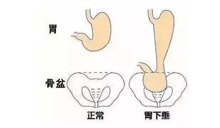 山西肛泰肛肠医院：胃下垂患者如何正确饮食？