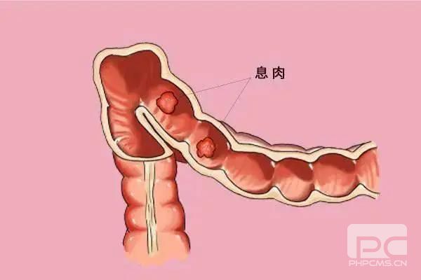 山西肛泰肛肠医院：肠息肉的危害有哪些？
