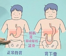 山西肛泰肛肠医院：哪些症状表明胃下垂了？