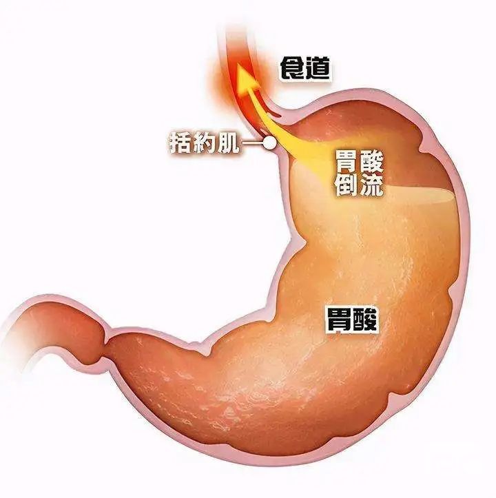 山西肛泰肛肠医院：胃酸过多要远离这些食物