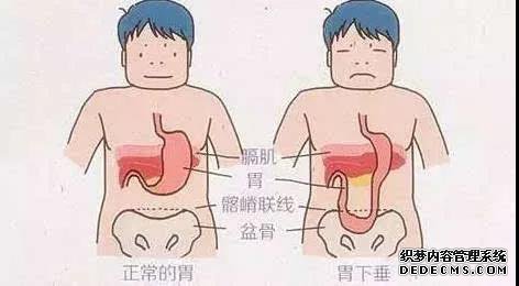 山西肛泰肛肠医院：如何预防胃下垂