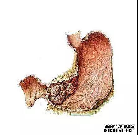 山西肛泰肛肠医院：长了一个胃息肉，会引发胃癌吗？