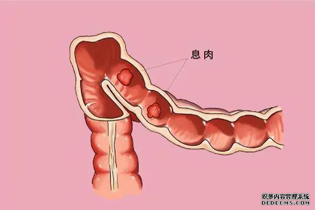 山西肛泰肛肠医院：上“肠息肉”的人 上厕所会出现这3个现象！