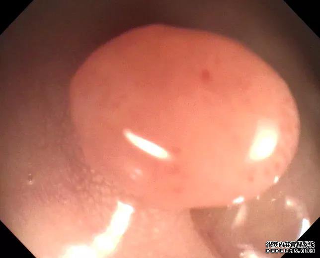 山西肛泰肛肠医院：长胃息肉的高位因素，快看看你有吗？