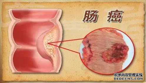 山西肛泰肛肠医院：结肠炎的六大危害，八大禁忌需注意！