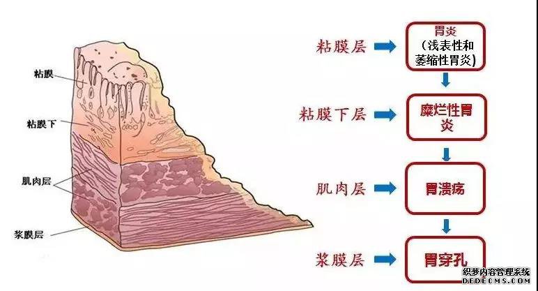 山西肛泰肛肠医院：引起中老年人胃溃疡的主要原因有哪些？