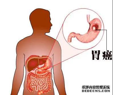 山西肛泰肛肠医院：胃溃疡月早期胃癌症状啥啥分不清，如何鉴别？