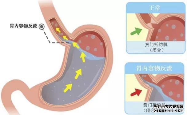 山西肛泰肛肠医院：反酸烧心！胃食管反流的“杀伤力”