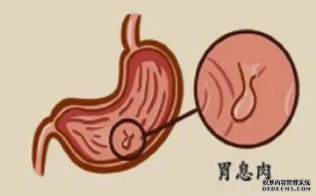 山西肛泰肛肠医院：胃里长了息肉严重吗？