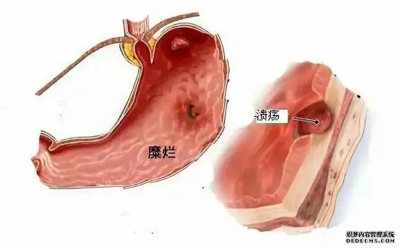 山西肛泰肛肠医院：为什么胃溃疡会反复发作？